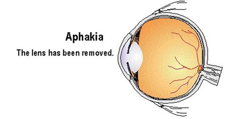 Aphakia .